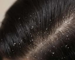 Hair Dandruff Care